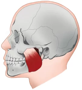 Masseter muscle botox for migraine